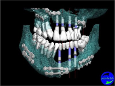 Wax up 3d positdental 7 w35rkr - Eugenol