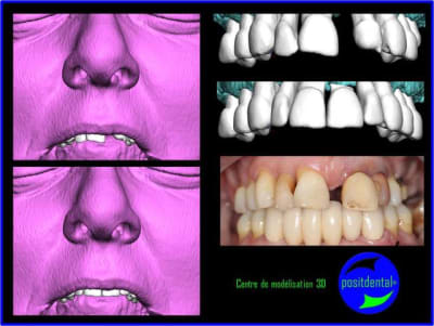 Wax up 3d positdental gjonab - Eugenol