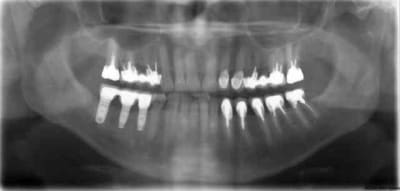 Xav2 ramxui - Eugenol