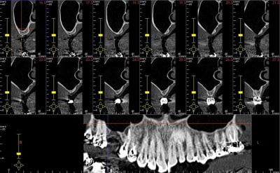 Absence de corticale wlfmqq - Eugenol