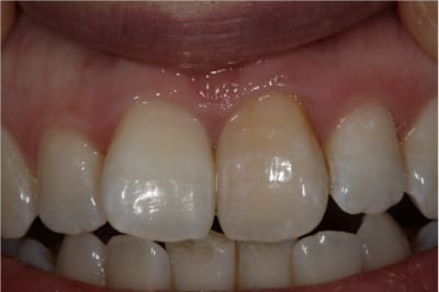 Acan mk7ere - Eugenol