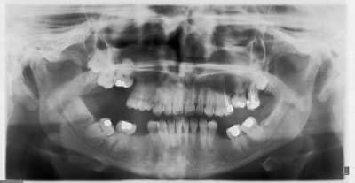 Ankylose dnamc6 - Eugenol