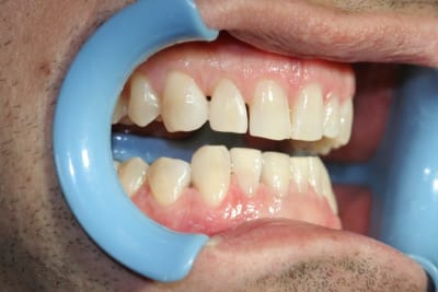 Apres ynjta2 - Eugenol