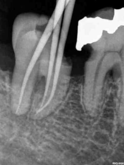 Avant anesth mcaety - Eugenol