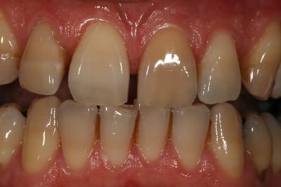 Avant hjwpli - Eugenol