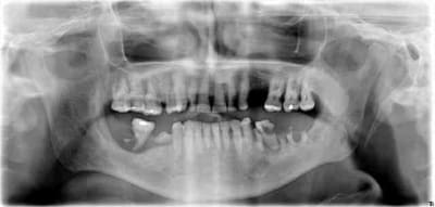 Bouche pourrie xvdvwy - Eugenol