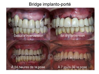 Bridge implanto port  02 nagomf - Eugenol