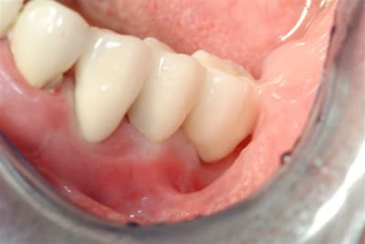 Céramiques en bouche azyt27 - Eugenol