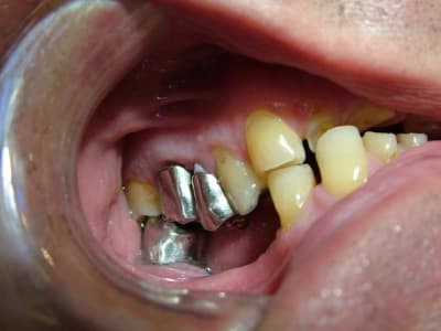 Côté droit 1 o1btoi - Eugenol