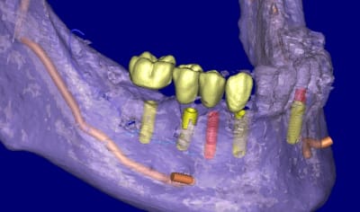 Canal 3d soft r56lsl - Eugenol