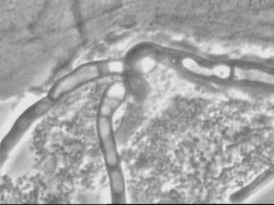 Candida hax4oz - Eugenol