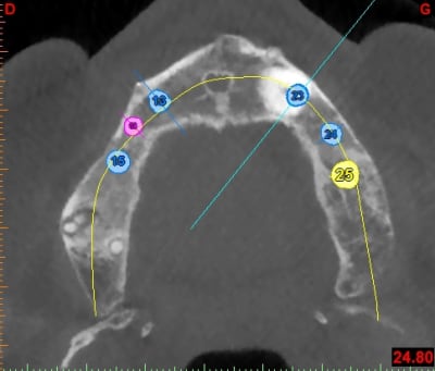 Canine axiale wvblwm - Eugenol