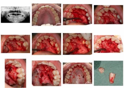 Canine ec4tpi - Eugenol