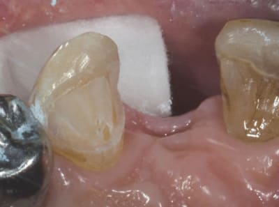 Cantilever b4j5ji - Eugenol