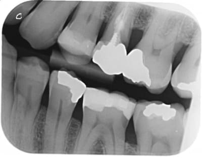 Carie1 igujaq - Eugenol