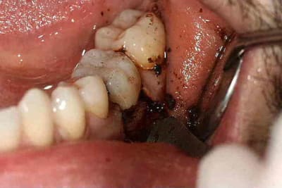 Carie sous gingivale 001 s36hqp - Eugenol