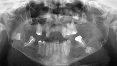 Cas clinique otp tlercd - Eugenol