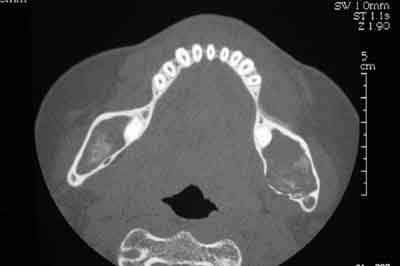 Cas clinique scanner 2 jnd6so - Eugenol