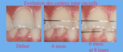 Centres inter incisifs 1 egore7 - Eugenol