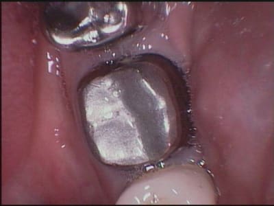 Cerec8 gihktm - Eugenol