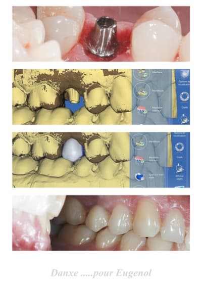 Cerec 6 ublxpc - Eugenol