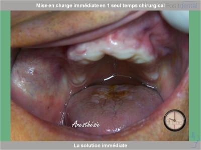 Chirurgie guidée mise en charge immédiate 0004 kupmnl - Eugenol