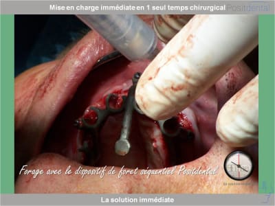 Chirurgie guidée mise en charge immédiate 0010 dusukp - Eugenol