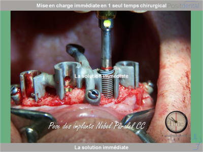 Chirurgie guidée mise en charge immédiate 0012 oc28jt - Eugenol