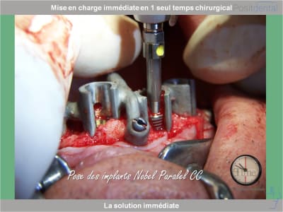 Chirurgie guidée mise en charge immédiate 0013 jjwkjo - Eugenol