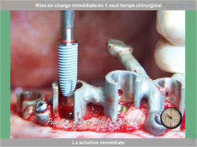 Chirurgie guidée mise en charge immédiate 0015 zvyxqo - Eugenol