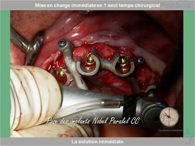 Chirurgie guidée mise en charge immédiate 0017 jiq7en - Eugenol