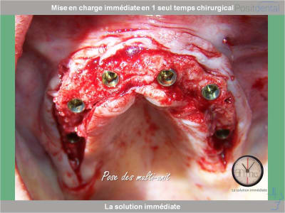 Chirurgie guidée mise en charge immédiate 0019 nphwn6 - Eugenol