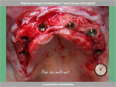 Chirurgie guidée mise en charge immédiate 0020 cruael - Eugenol