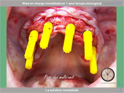 Chirurgie guidée mise en charge immédiate 0021 kxdmhr - Eugenol