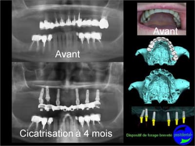 Cicatrisation gingivale suite eimci positdental 15 ia0ict - Eugenol