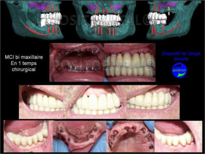 Cicatrisation gingivale suite mci positdental 1 faoq7j - Eugenol