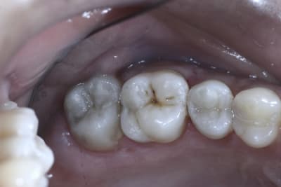 Compos 004 radomo - Eugenol