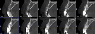 Cone beam h9uflb - Eugenol