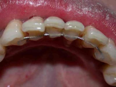 Contention ncooqu - Eugenol