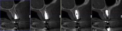 Corticale apr s implantation qndv4g - Eugenol