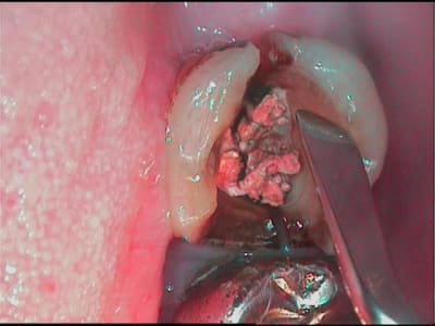 Coulé m1cwmo - Eugenol