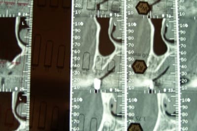 Coupe avec implant 8 5 yid3g7 - Eugenol