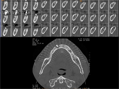 Coupe scanner extraction implantation 3 zifl2c - Eugenol