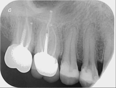 Couronne 17 tsu3he - Eugenol