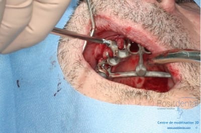 Déoulé d une mci dr r - Eugenol