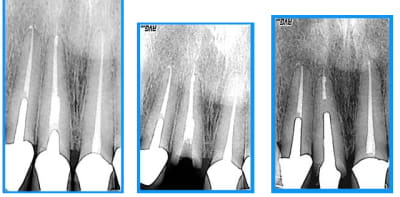 Dépassement dt5hca - Eugenol