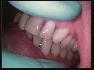 Debut traitement hy3w9q - Eugenol