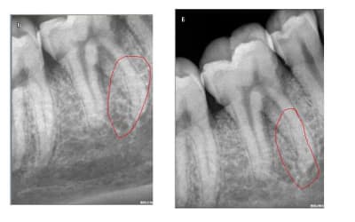 Dent fractur e phg246 - Eugenol