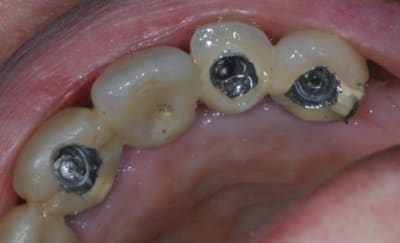 Depose bridge sur implants 1 eytrfu - Eugenol