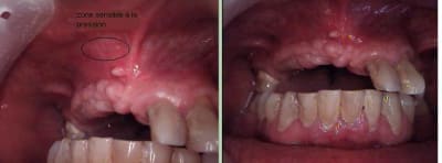 Douleur kvtuxl - Eugenol